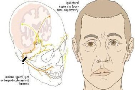 首大李健东贝尔面瘫生活中最常见的面瘫