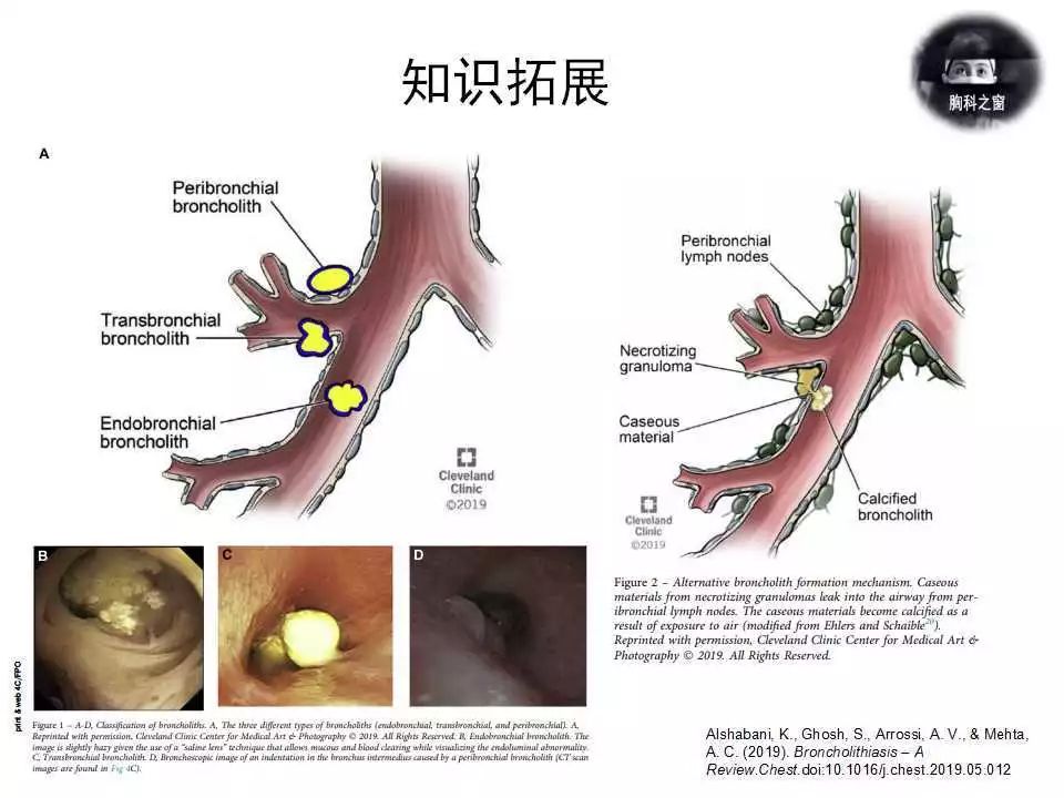 244期轮值病例结果竟然是支气管扩张