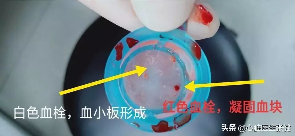 血管被血栓完全堵死就像一脚踏进沼泽地这个急性心梗居然没放支架