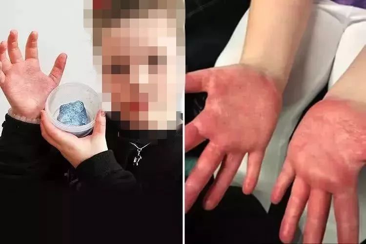 昆明皮肤病医院动态跟踪——春季过敏高发期如何有效应对？