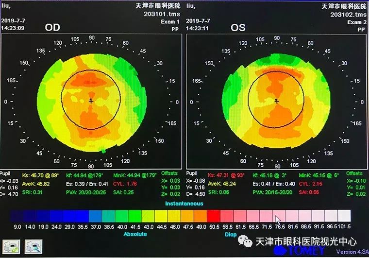 病例分享適合高度近視的軟性隱形眼鏡