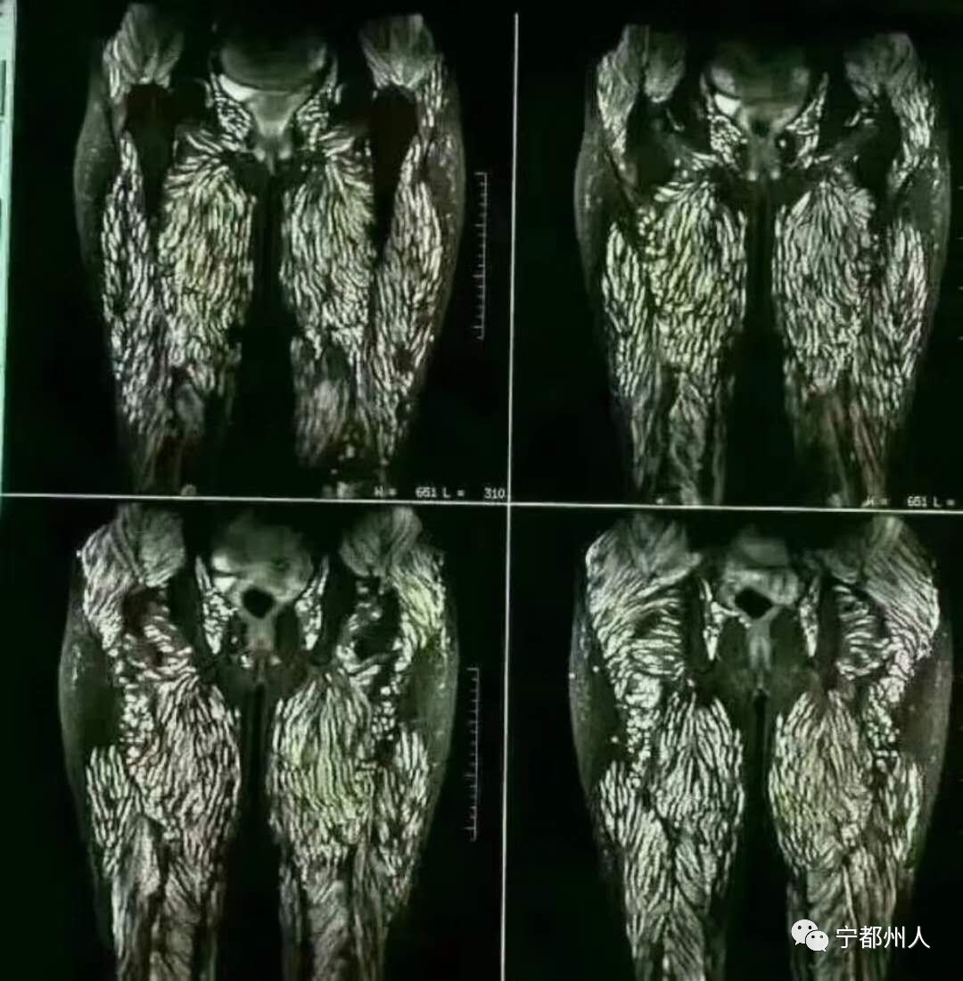 宁都喜欢吃生鱼片的看过来肝吸虫全身寄生