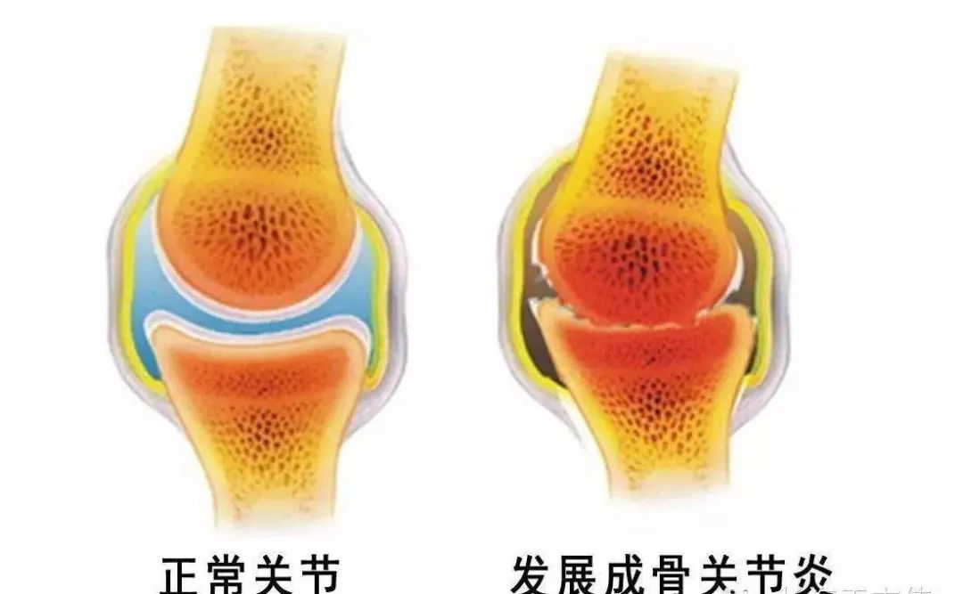 【汤汤播报】 走路老是腿打软,咋回事?_膝关节