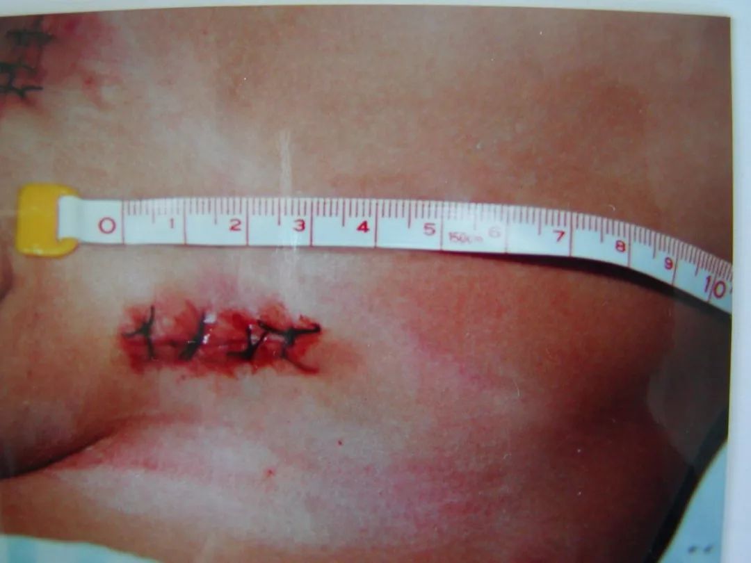 疝气手术后疤痕照片图片