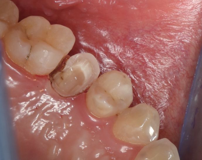 牙体缺损修复的预防学考量范丽苑副教授