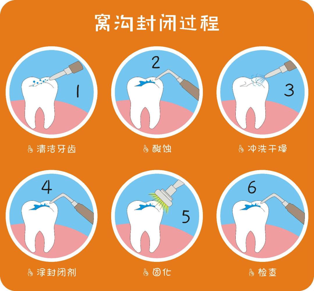 窝沟封闭会不会有副作用呢六安竹子口腔医院为你科普