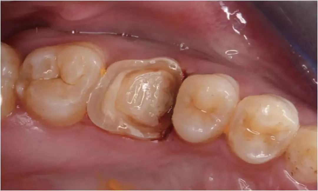 牙体缺损修复的预防学考量范丽苑副教授