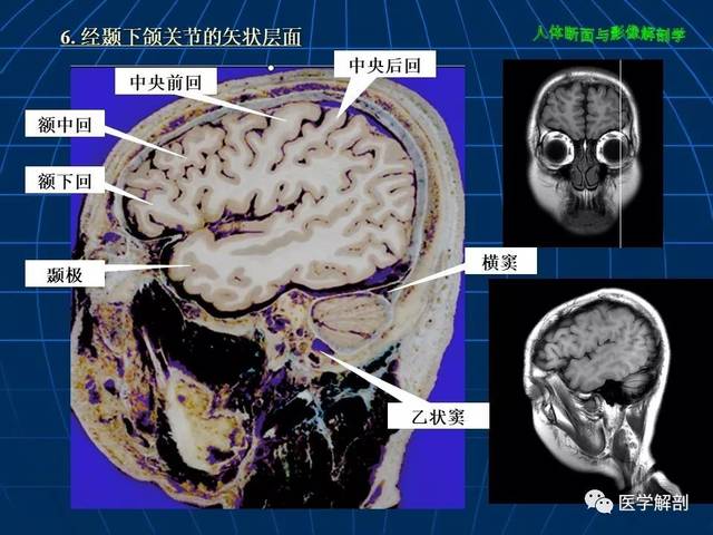 颅脑大体断层解剖(矢状位)