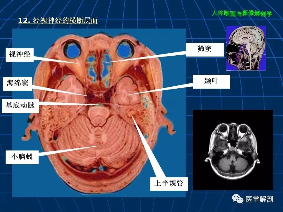 超讚顱腦大體及磁共振斷層解剖軸位