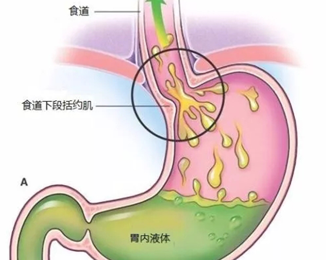 張璐食療學會養胃幹掉膽汁反流性胃炎這個殺手