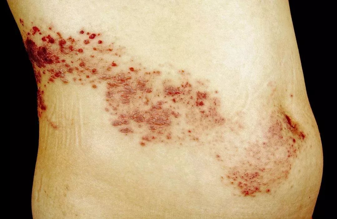 带状疱疹是个会完全康复的疾病由于它发作位置多在背部神经节中,且