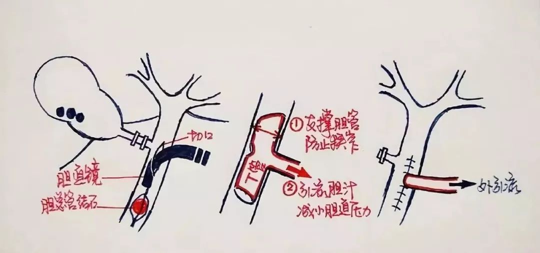 画说胆结石:胆道结石可以如此简单_胆囊