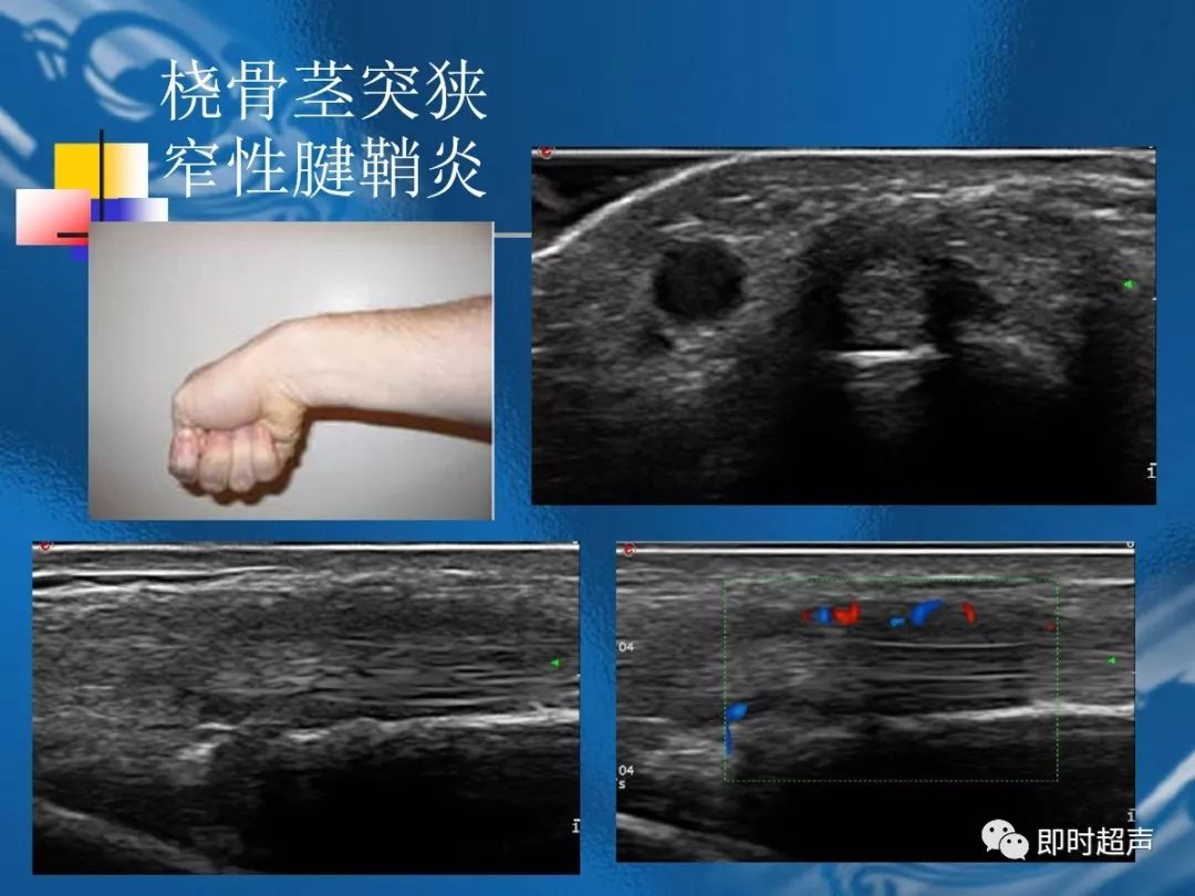 手腕部超声检查