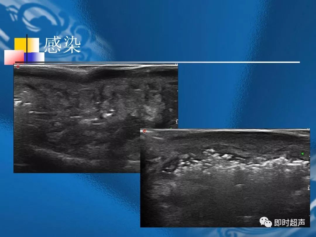 手腕部超声检查