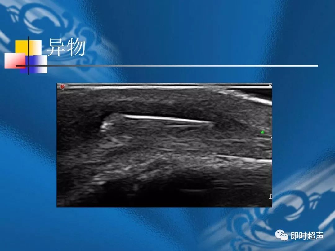 手腕部超声检查