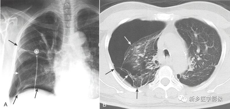 诊断误区:胸膜粘连时,即使在发生气胸的情况下,也可能会出现部分而非