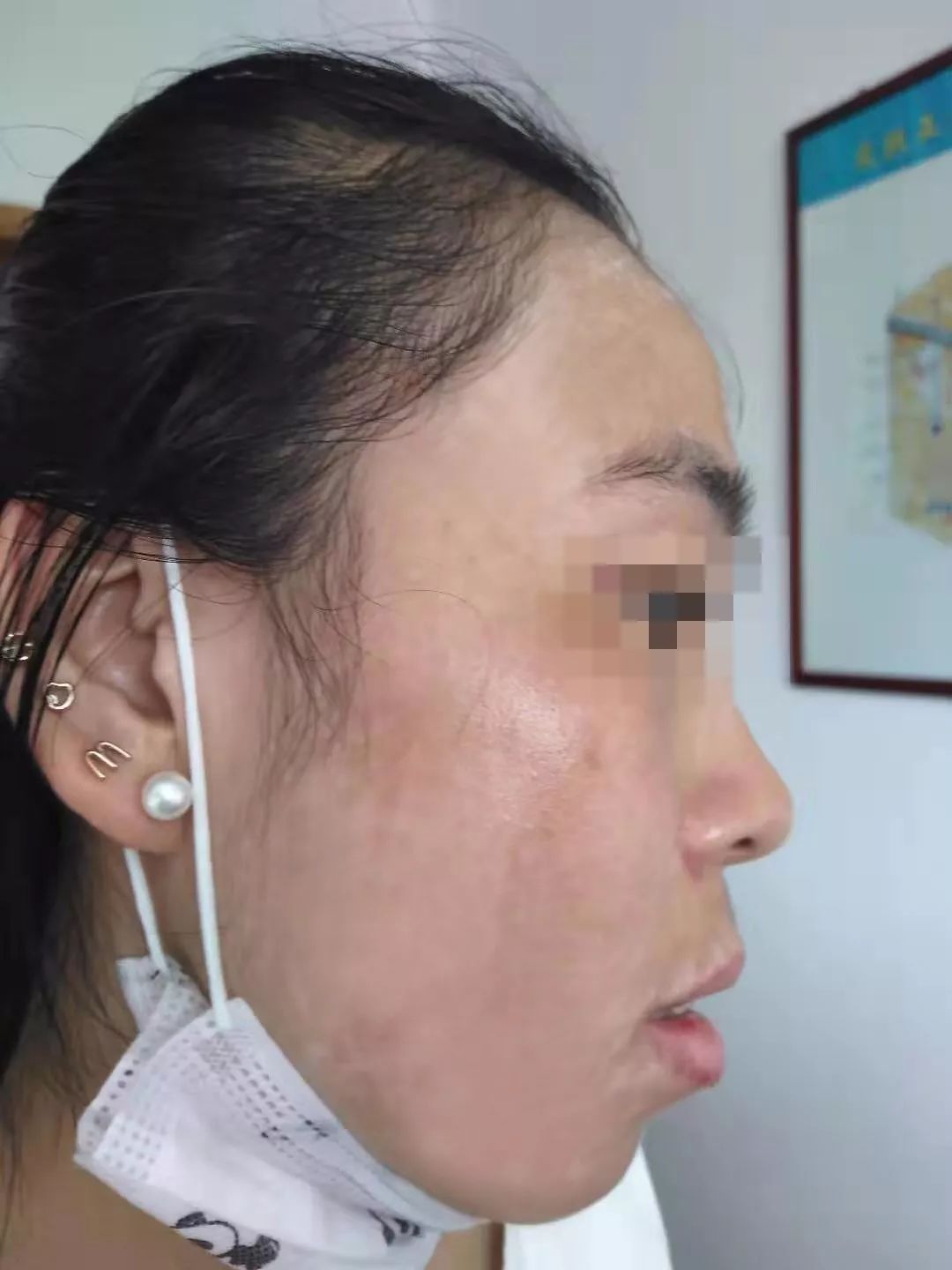 28岁脸上长满白癜风?看看她三个月治疗后现状..._白斑