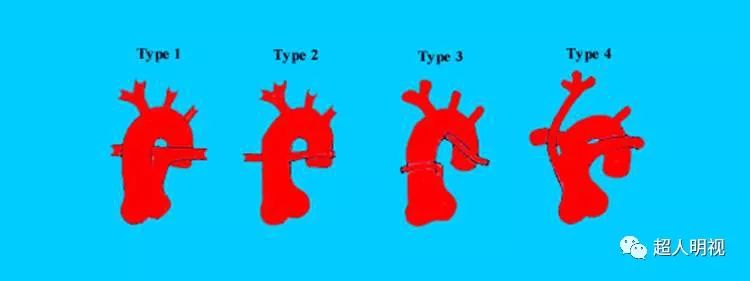 永存动脉干寥寥数语谈胎心之四