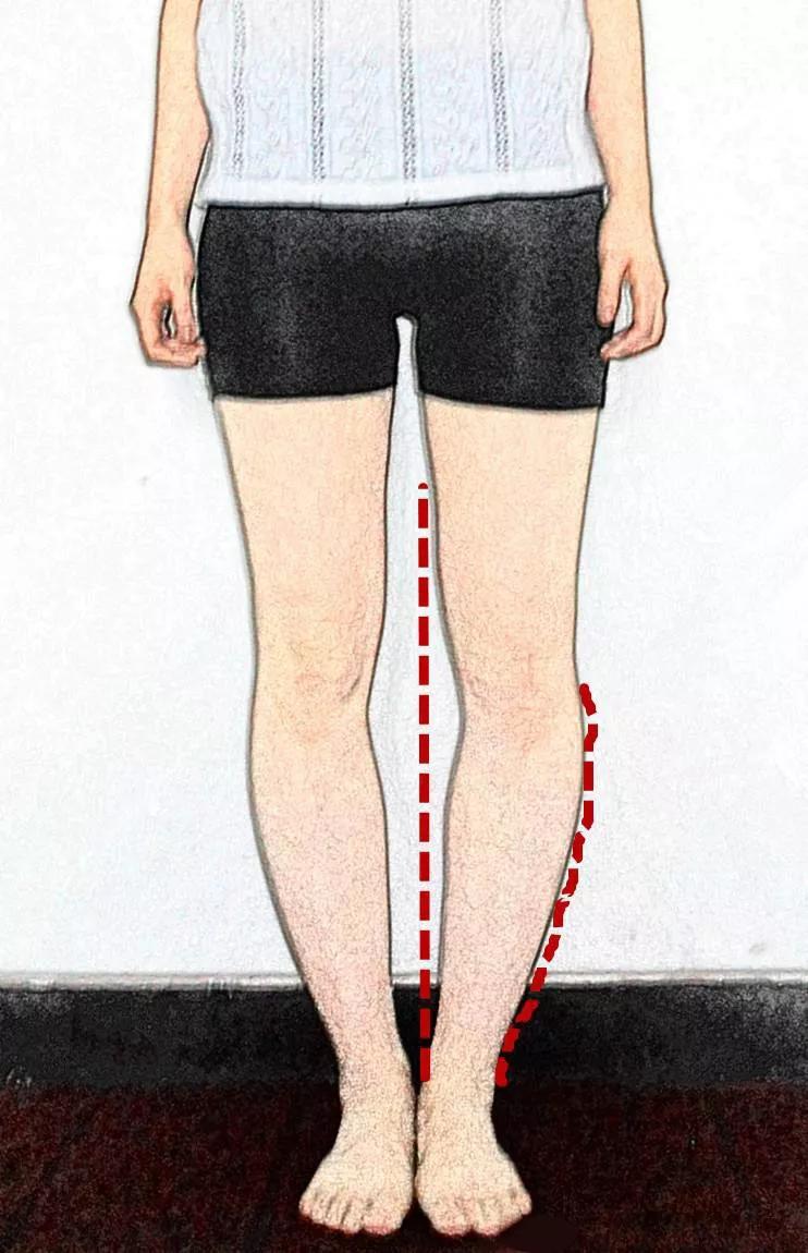 从人体正面观察,大腿,小腿所成角度大于180°(腿外侧角度)