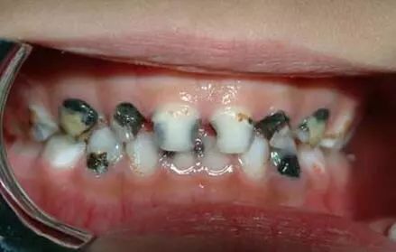 儿童涂氟——健康成长由"齿"开始_牙齿