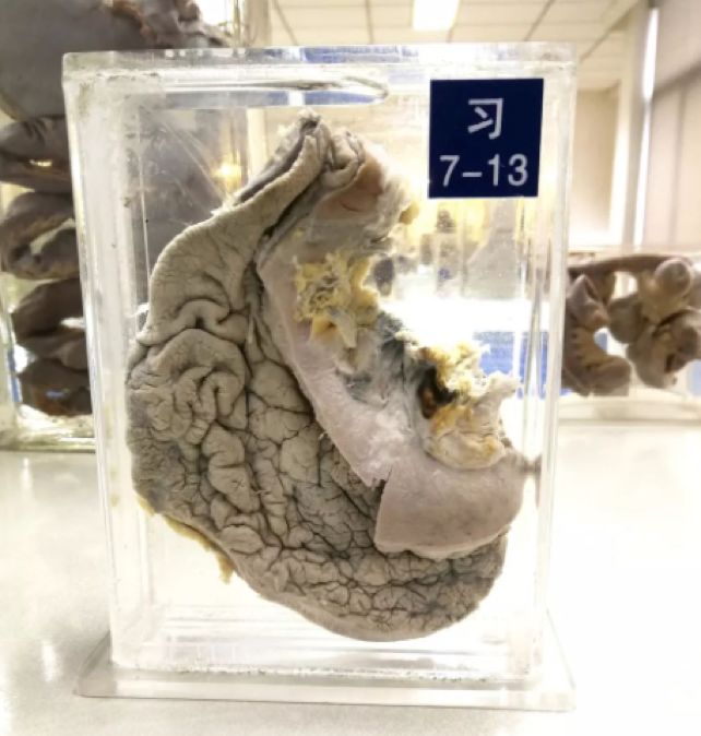 这是一个患了胃癌的胃:胃癌北京医院肿瘤内科主任李琳在2018年12月2