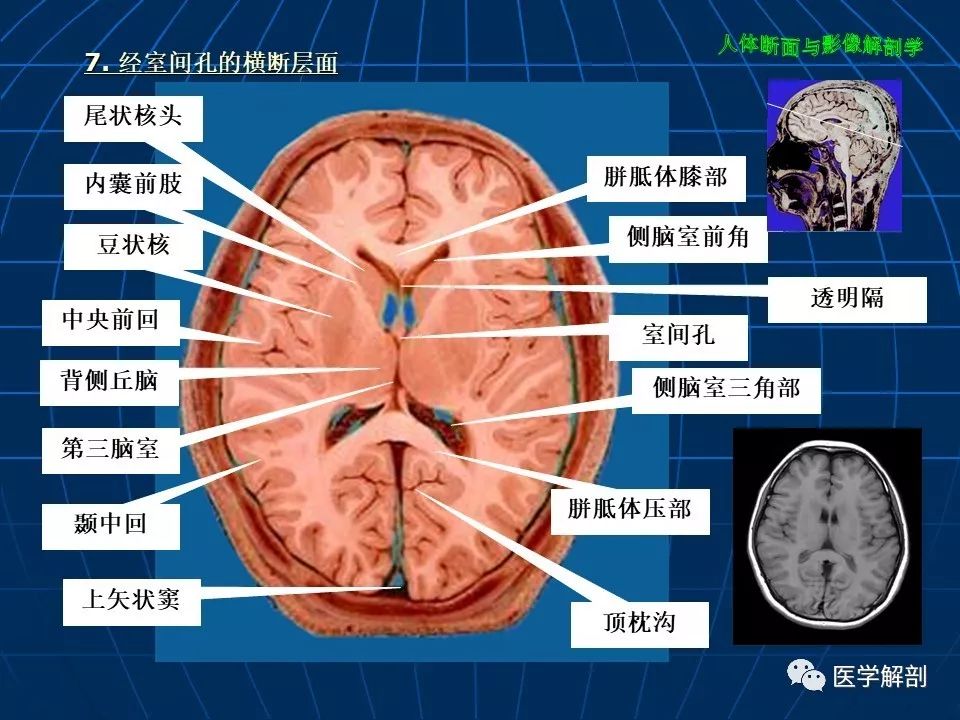 超赞颅脑大体及磁共振断层解剖轴位