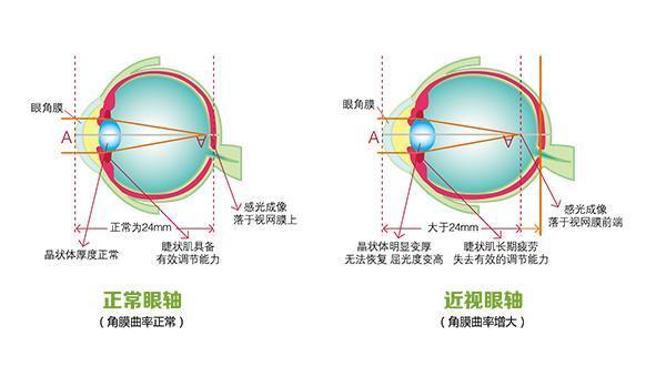 眼睛近视分析图图片