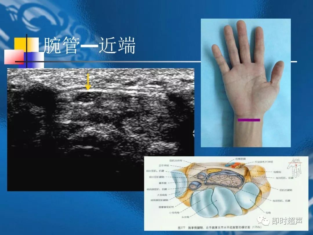手腕部超声检查