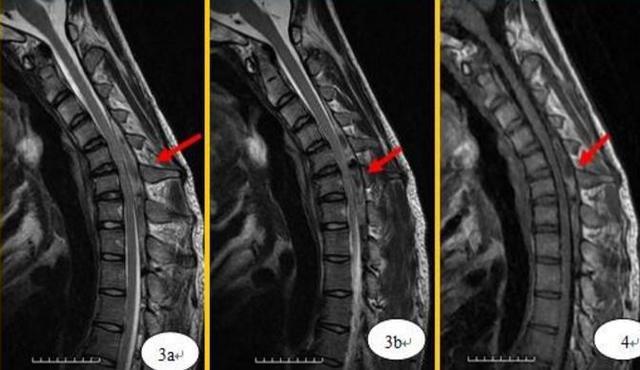 少年手部无力警惕平山病仲骏教授科普系列