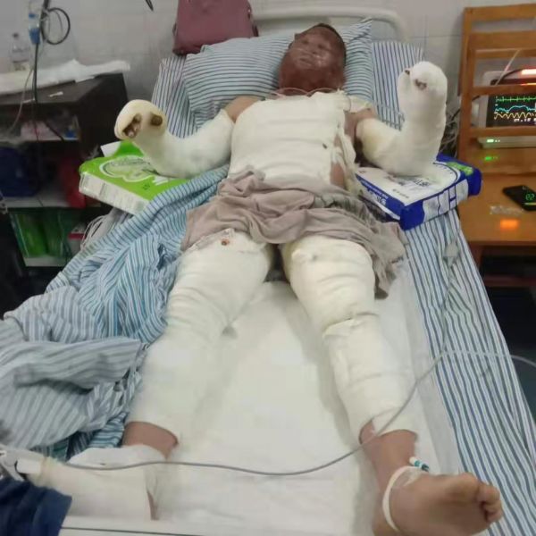 吉安一男子煲汤时煤气罐突然爆炸,严重烧伤!触目惊心.