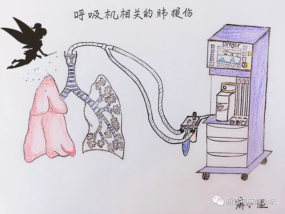 第234讲呼吸机诱导的肺损伤刘睿教授