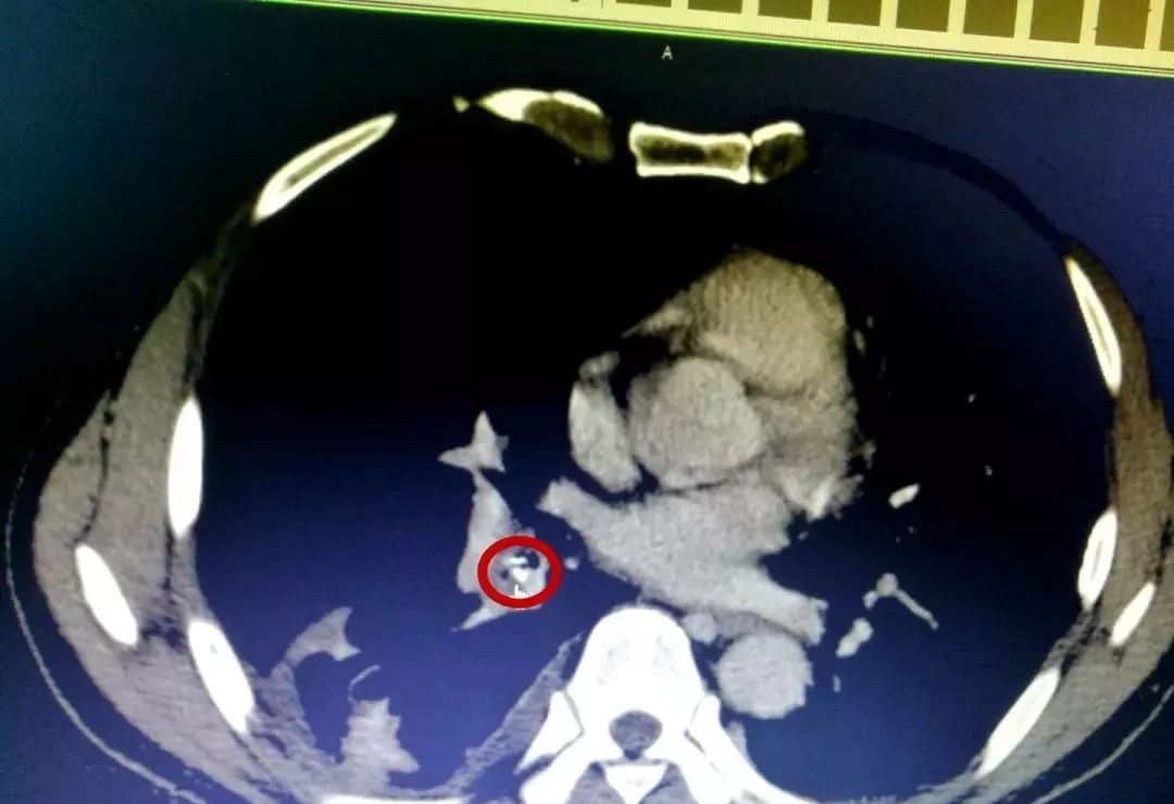 昌吉州65岁男子咳嗽2年服药不见效,原来是鸡骨头卡在气管上._异物