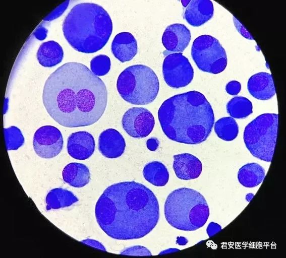 胸水涂片1diff通道中多个核上方出现异常散点,提示出现高荧光细胞并且