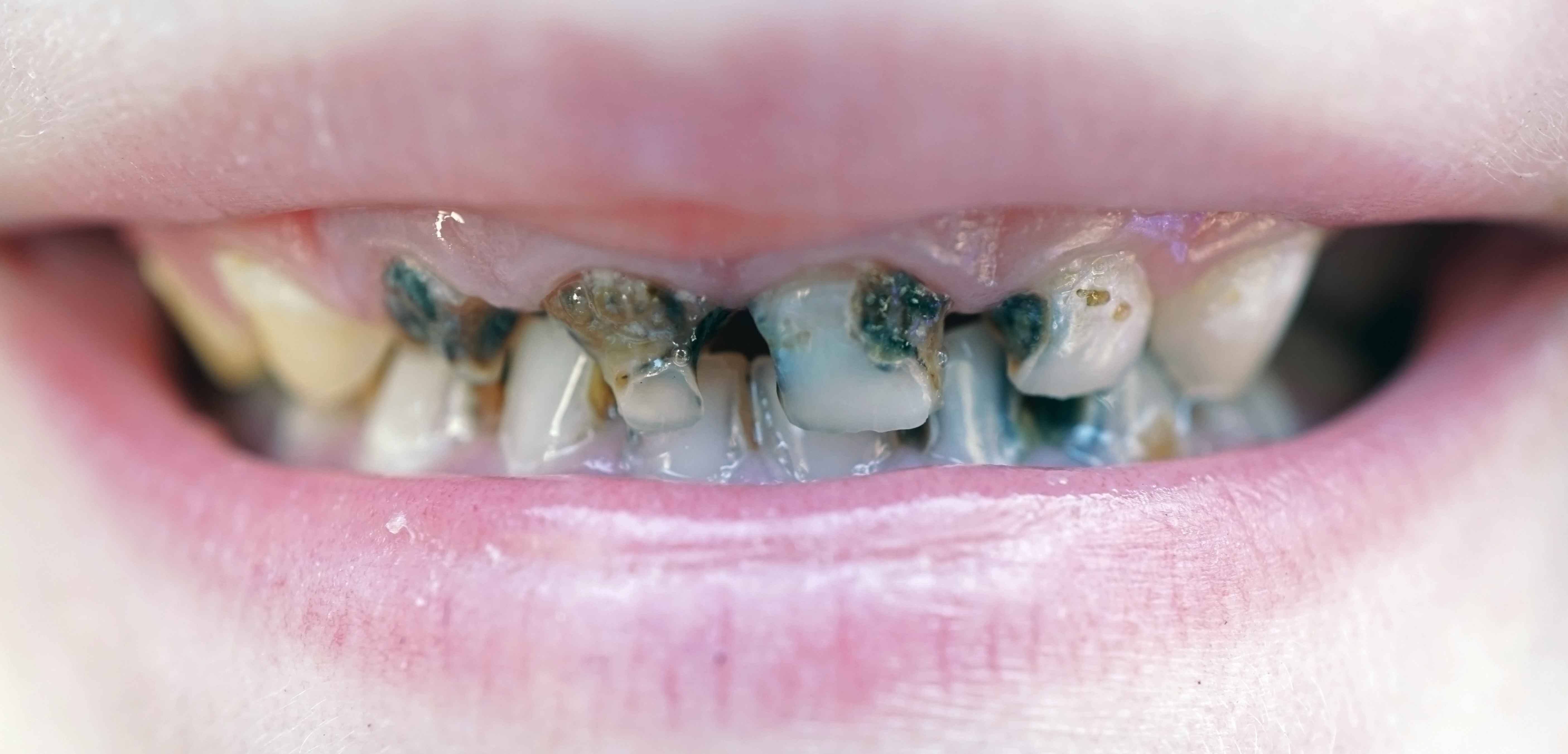 试想一个5岁的孩子,牙齿的抗性能有多强?