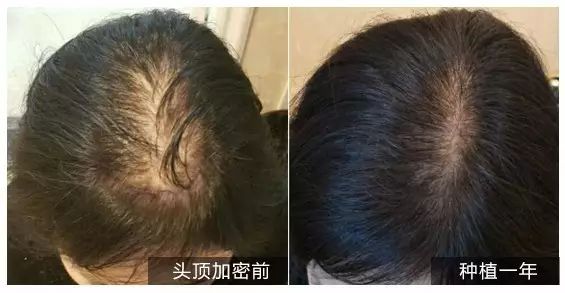 均由受访者本人提供如果想知道自己的毛囊健康情况脱发类型或原因请到