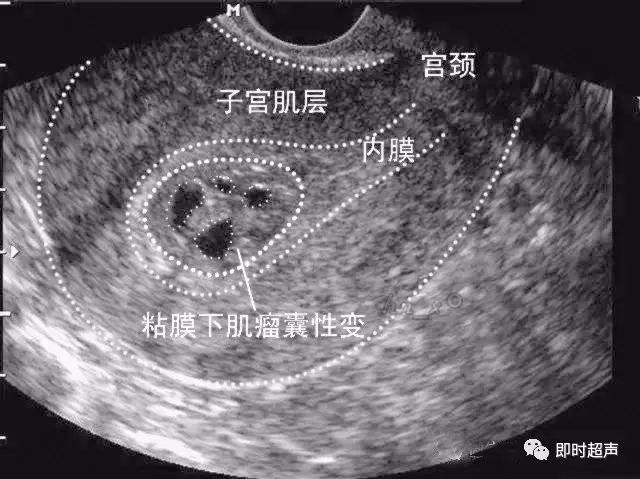 子宫肉瘤彩超图片图片