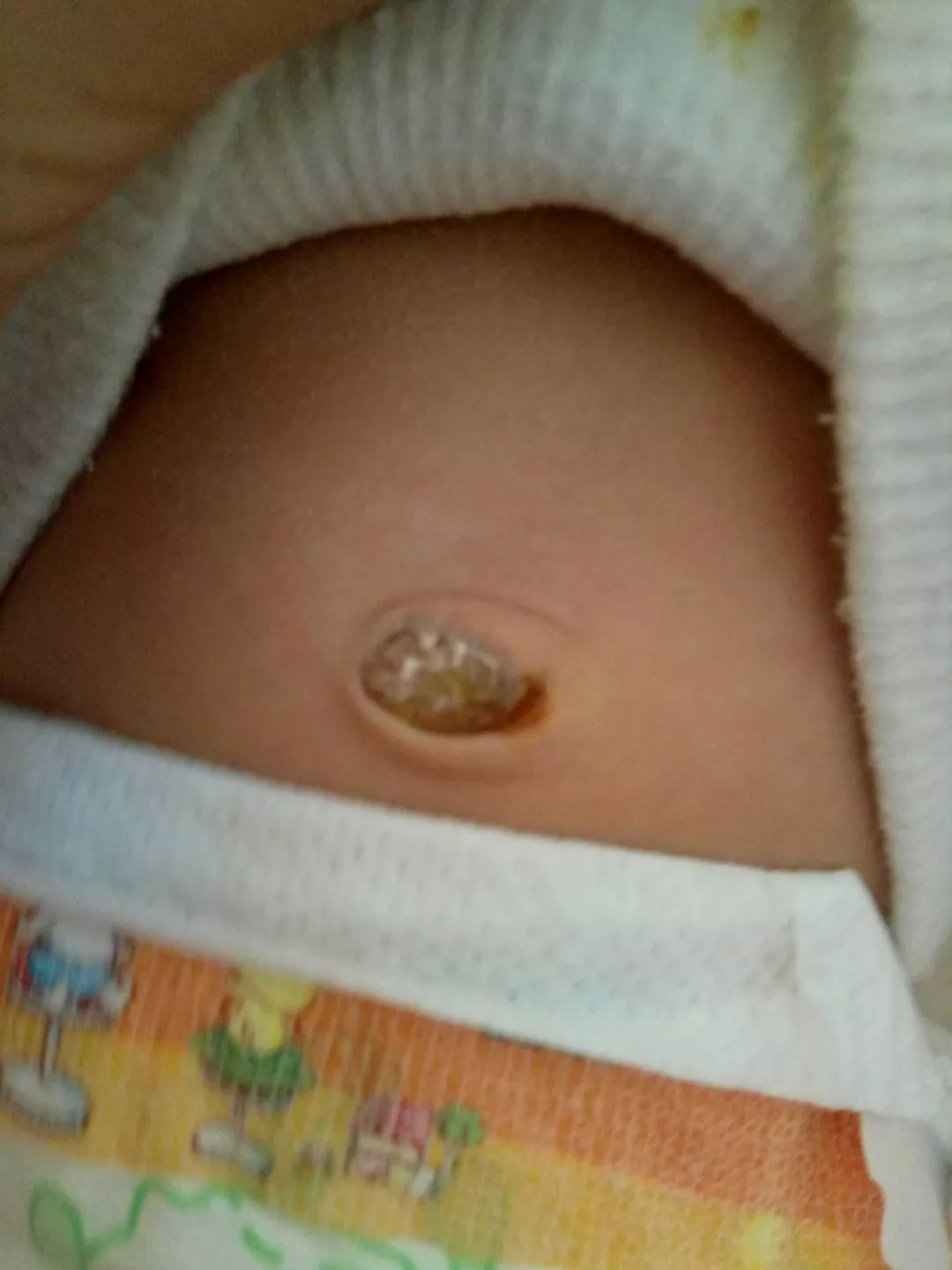 宝宝肚脐有个洞图图片
