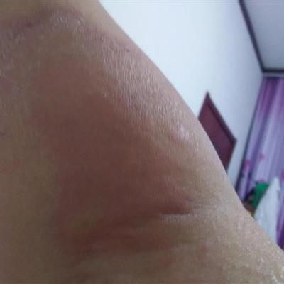 慢性荨麻疹吃什么,这几点一定要注意!_患者