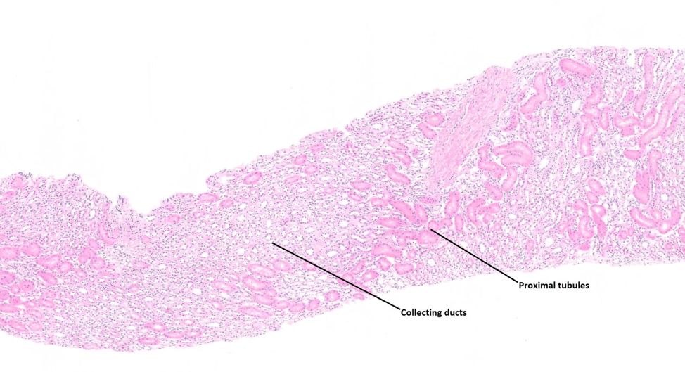 腎小管間質之皮質腎活檢導讀
