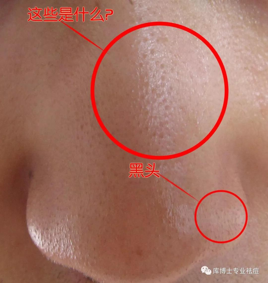 库博士小讲堂与1000万螨虫同床共枕不想变成螨虫脸就这样做