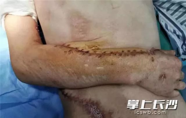 男子车祸后险截肢,右臂在腹部"寄养"3周后,保住了!