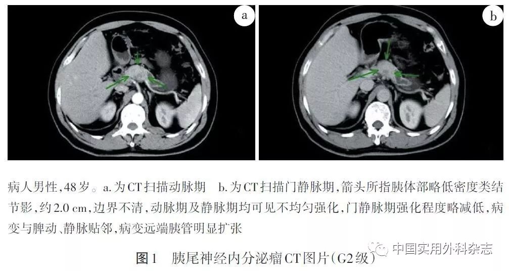 专题笔谈胰腺神经内分泌肿瘤的影像学诊断
