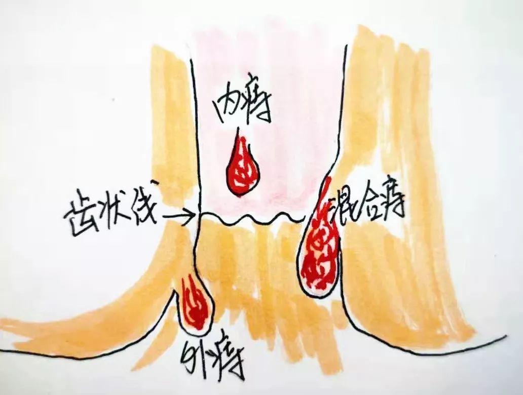 痔疮是一种慢性疾病,是肛门直肠底部及肛门粘膜的静脉丛发生曲张而