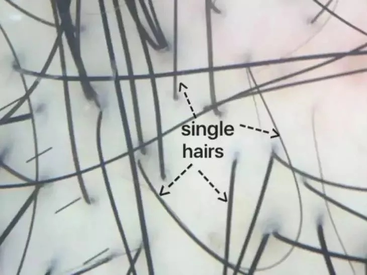 想判断毛囊萎缩和毛囊闭合有何区别教你移几个非常简单的方法