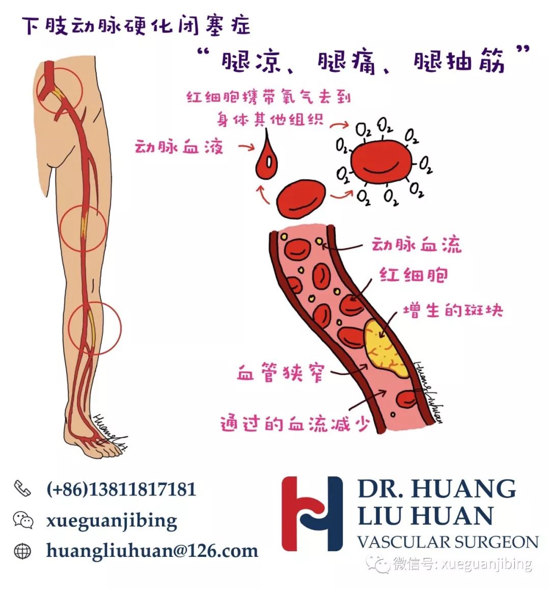 下肢动脉粥样硬化闭塞症.这是一种慢性病变.