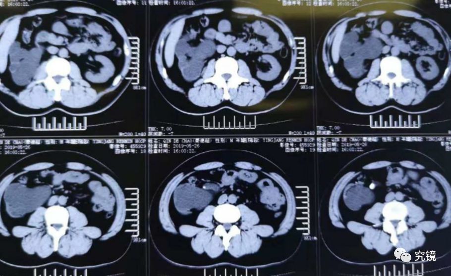 主要檢查結果:腹部ct:右側輸尿管上段結石伴右腎重度積水,右腎皮質