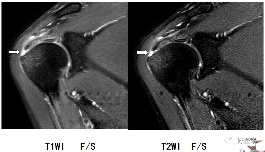 冈上下肌撕裂冈上下肌撕裂盂唇损伤要点程度:磨损,撕裂部位:上,前上