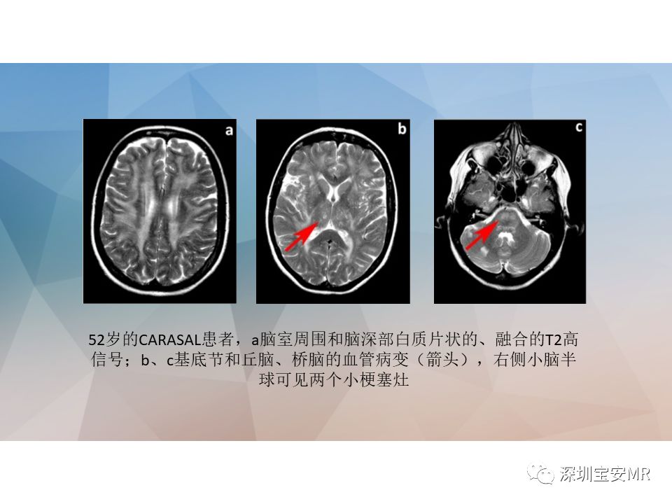 遺傳代謝性腦病的mri鑑別診斷