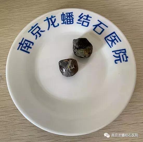 我的胆囊结石从来都没有疼过,这种情况需要手术治疗吗?