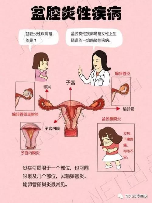 盆腔炎是女性妇科疾病中较常见的一种疾病